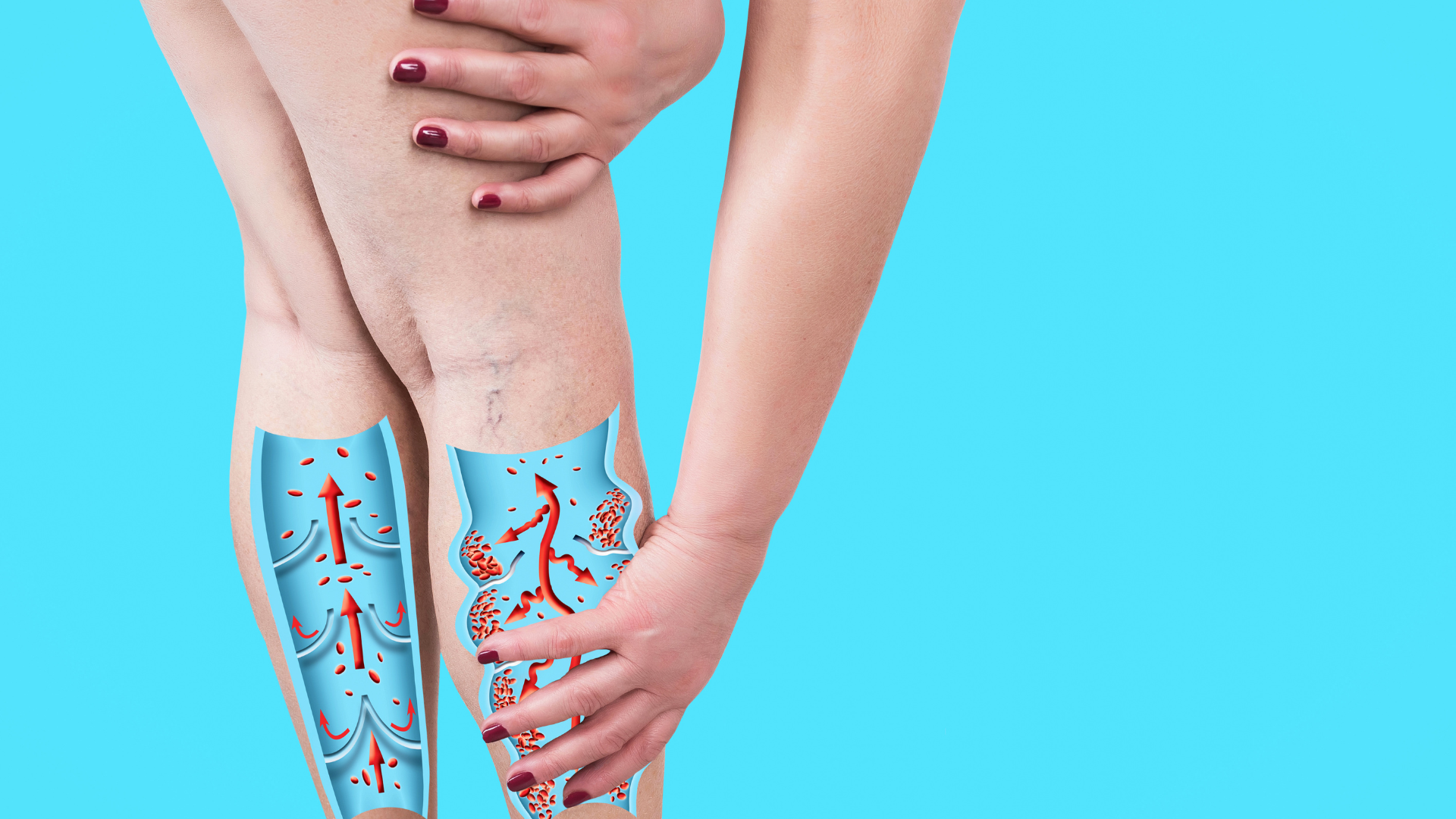 When Is the Best Time to Treat Varicose Veins?