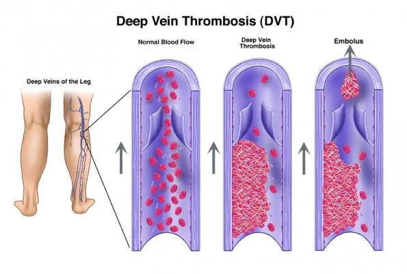Understanding the Dangers of Deep Vein Thrombosis (DVT)